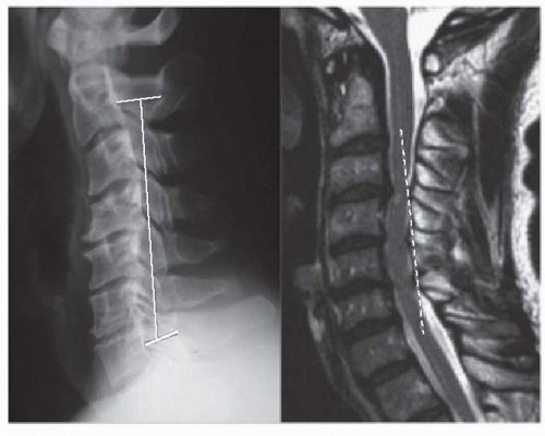 Controversies, Myths, And Realities Regarding The Surgical Treatment Of 