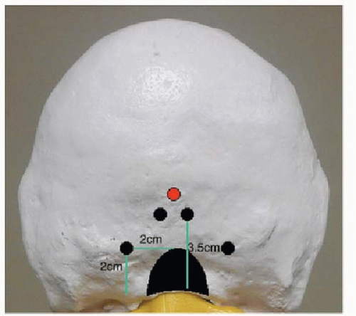 Occipital Fixation Techniques: Keel Plate versus Screws through ...