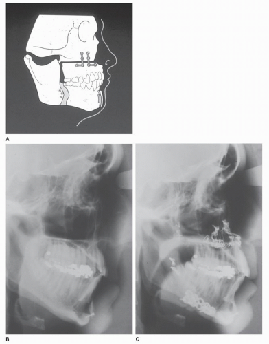 Obstructive Sleep Apnea: Surgical Treatment | Neupsy Key