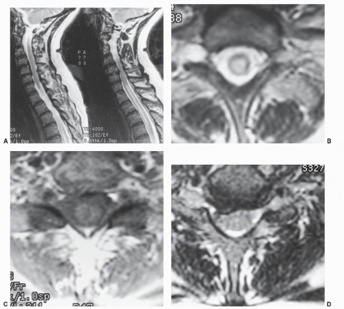 Magnetic Resonance Imaging Of The Cervical Spine And Spinal Cord 