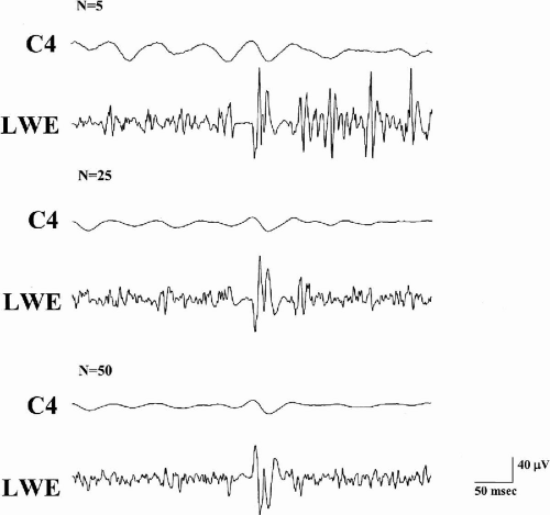 Pathophysiology of Myoclonic Epilepsies | Neupsy Key