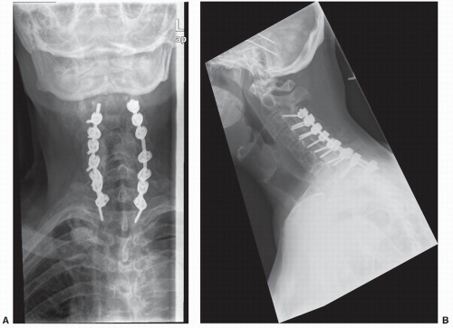 Nonoperative Management And Treatment Of Spinal Injuries Neupsy Key 6253