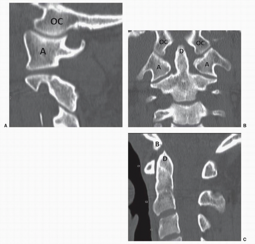 Atlanto Occipital Injuries Neupsy Key 1090