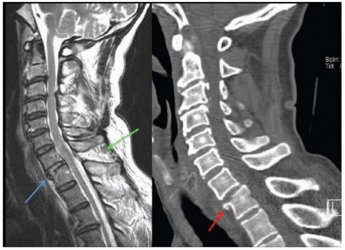 Traumatic Spinal Cord Injury | Neupsy Key