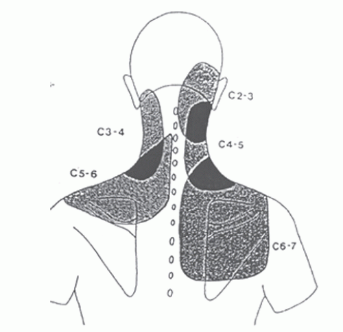 Cervical Degenerative Disk Disease: Overview and Epidemiology | Neupsy Key