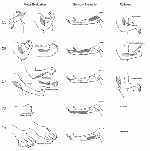 Cervical Degenerative Disk Disease: Overview and Epidemiology | Neupsy Key