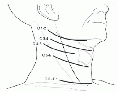 Anterior Cervical Discectomy and Fusion (ACDF) | Neupsy Key