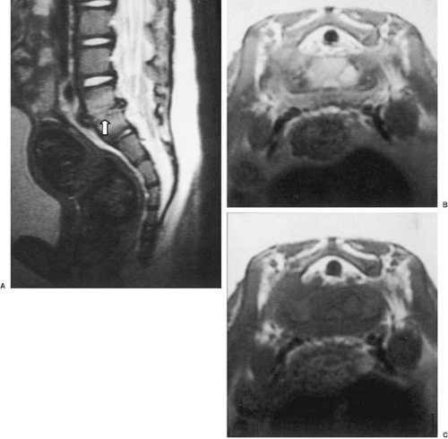 Infections of the Nervous System | Neupsy Key