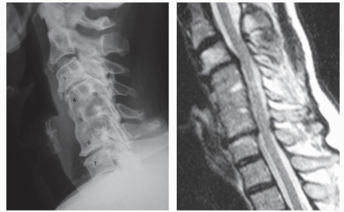 The Prevention of Adjacent Segment Disease Associated with Cervical