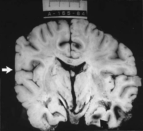 Postnatal Trauma and Injuries by Physical Agents | Neupsy Key