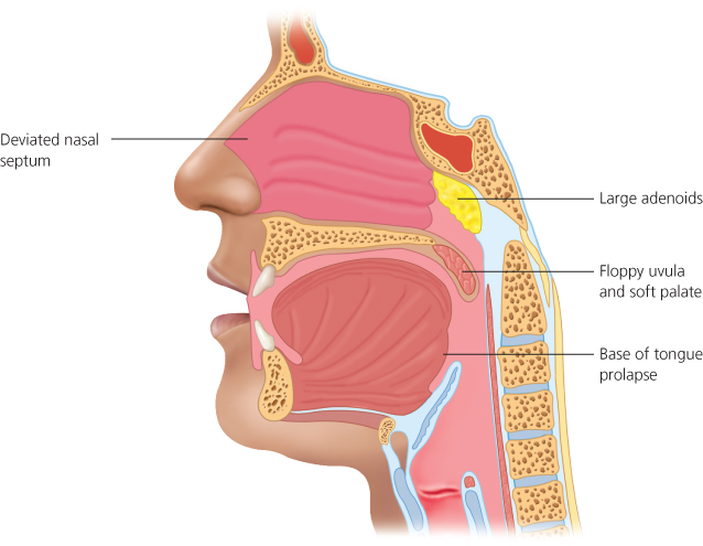 Sleep Apnoea Syndromes | Neupsy Key