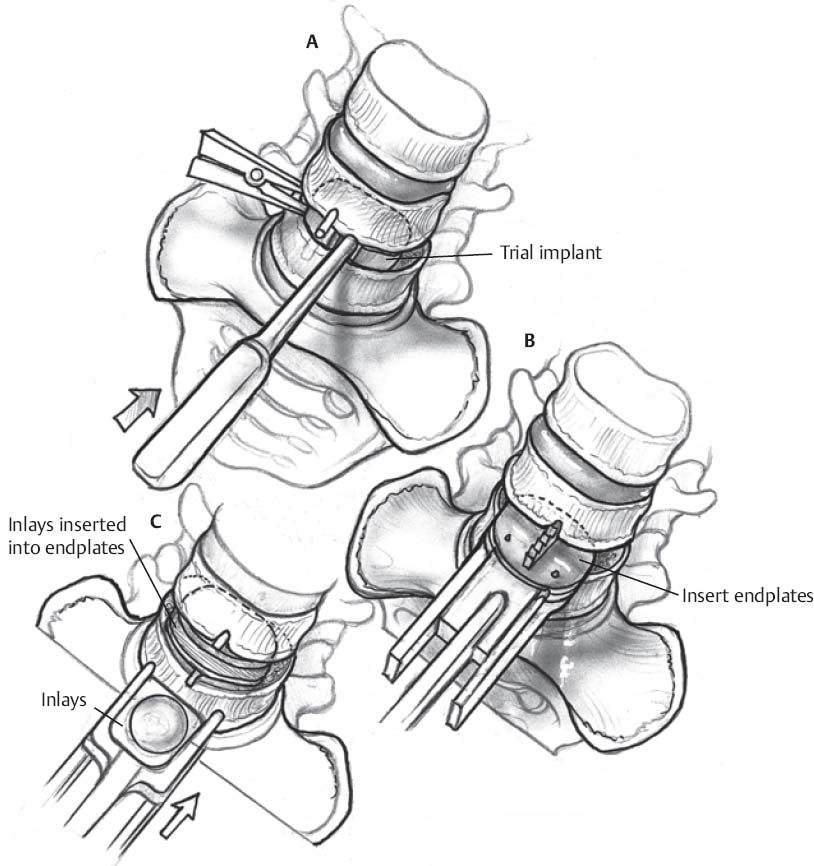 Lumbar Arthroplasty | Neupsy Key