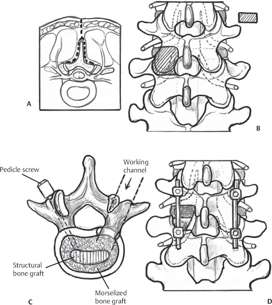 Posterior Lumbar Interbody Fusion Neupsy Key