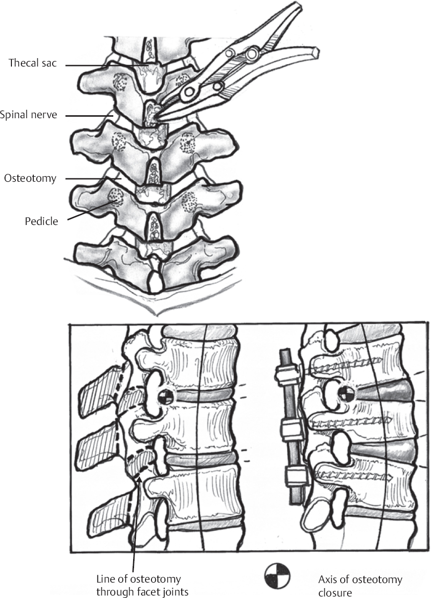 Correction of Degenerative Lumbar Scoliosis | Neupsy Key