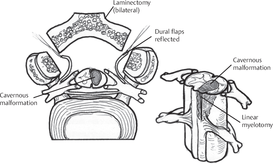 Spinal Cord Cavernous Malformations | Neupsy Key