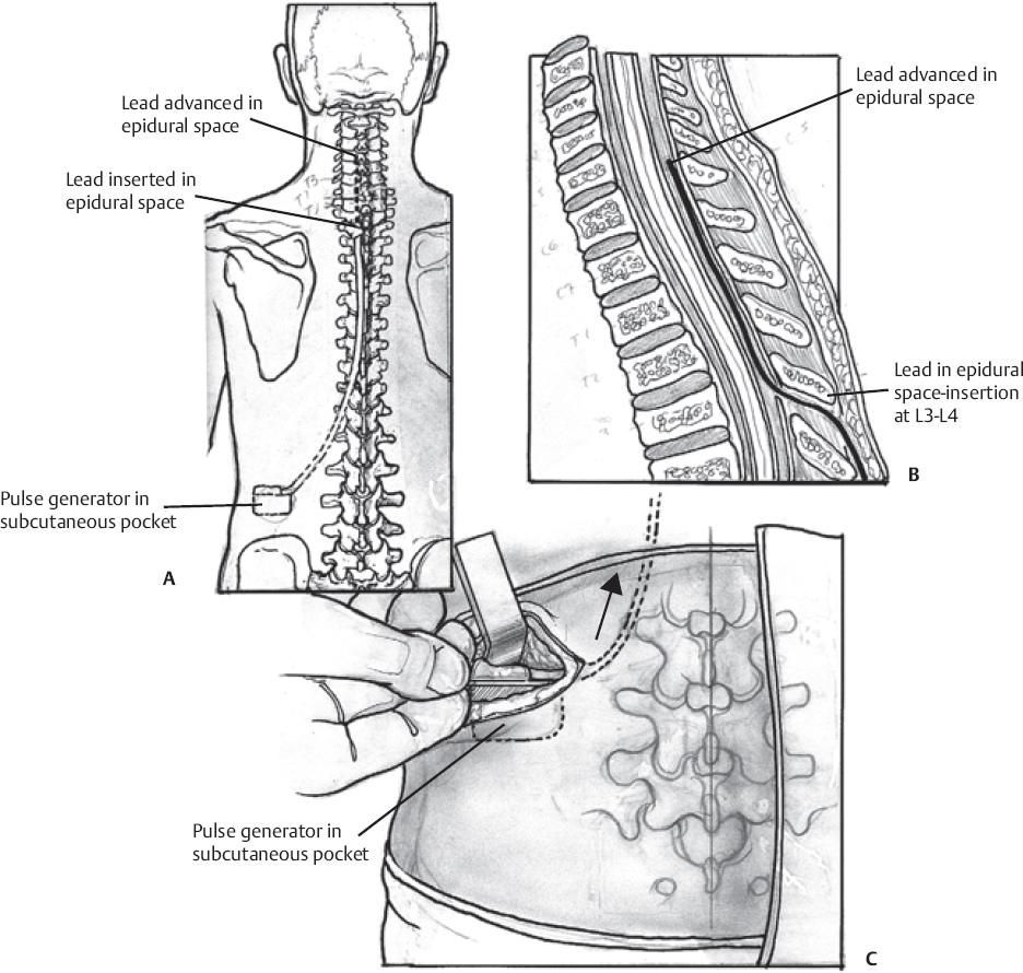 abbott spinal cord stimulator burst settings