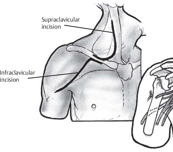 Supraclavicular Brachial Plexus