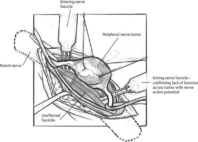 Resection of Peripheral Nerve Tumor | Neupsy Key