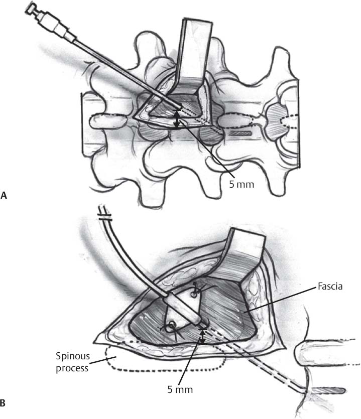 Posterior Lumbar Interbody Fusion Neupsy Key