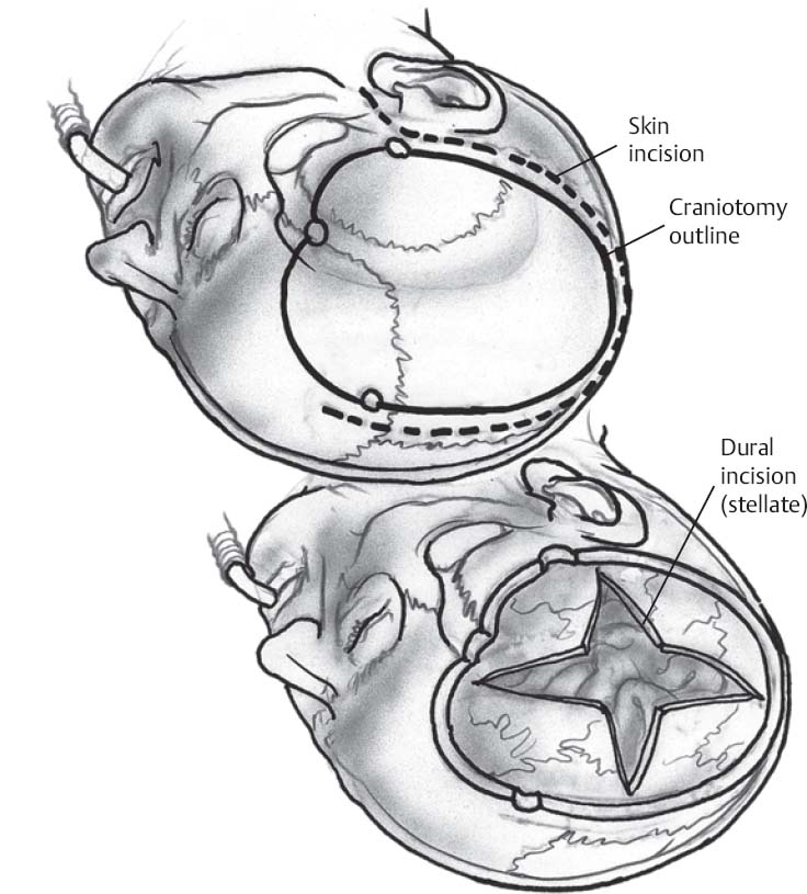 Trauma Flap  Hemicraniectomy - cnsorg