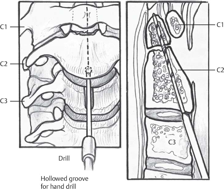 posterior screw fixation odontoid fracture