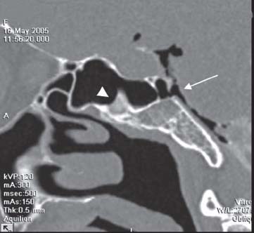 Imaging in Endoscopic Paranasal Sinus and Skull Base Surgery: Three ...