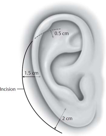 auditory brainstem implant