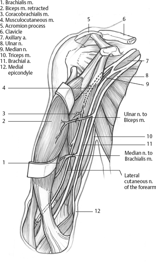 Fascicular Nerve Transfers to Restore Elbow Flexion | Neupsy Key