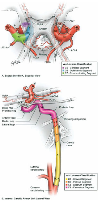 Paraophthalmic aneurysm