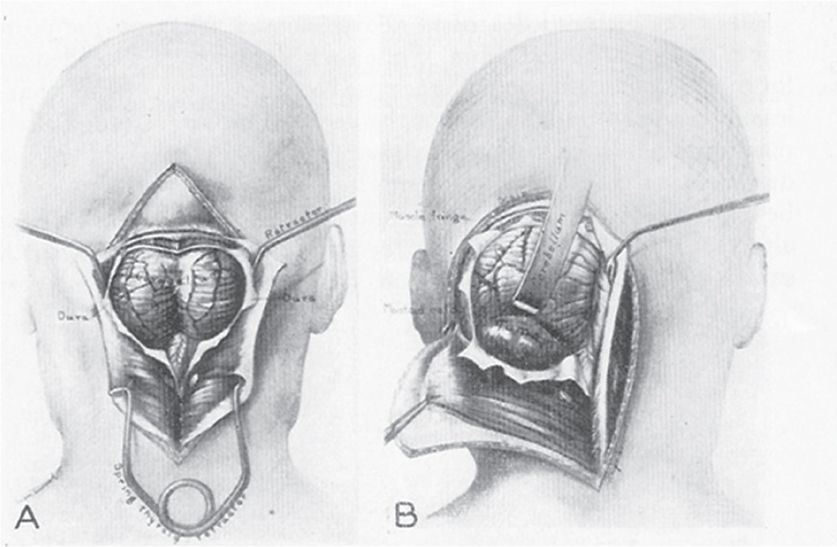 Surgery Of The Posterior Cranial Fossa Historical Aspects Neupsy Key