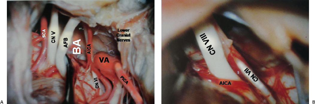 Microsurgical Anatomy of the Posterior Cranial Fossa | Neupsy Key