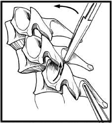 Cervical Open Reduction Techniques: Anterior and Posterior Approaches ...