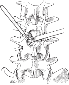 Open and MIS Lumbar Microdiscectomy | Neupsy Key