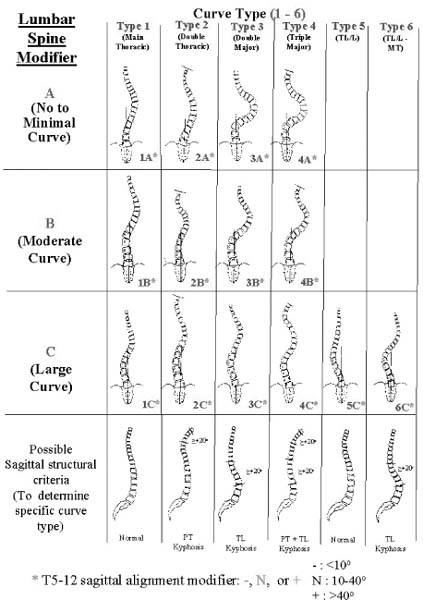 A New Classification System Of Adolescent Diopathic Scoliosis | Neupsy Key