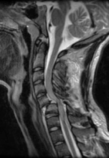 Cervical Spine Trauma | Neupsy Key