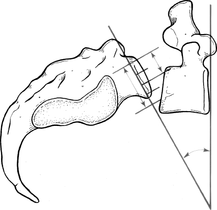 Lumbar Spondylolisthesis | Neupsy Key