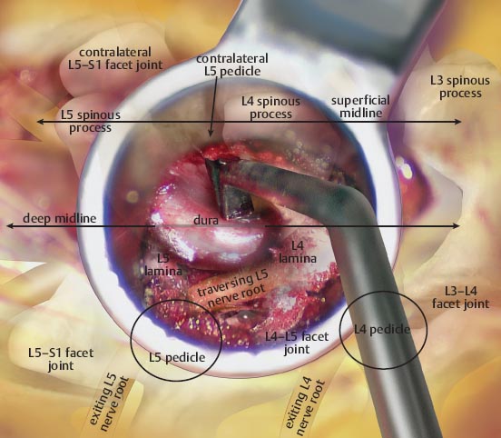 Minimally Invasive Laminectomy Neupsy Key