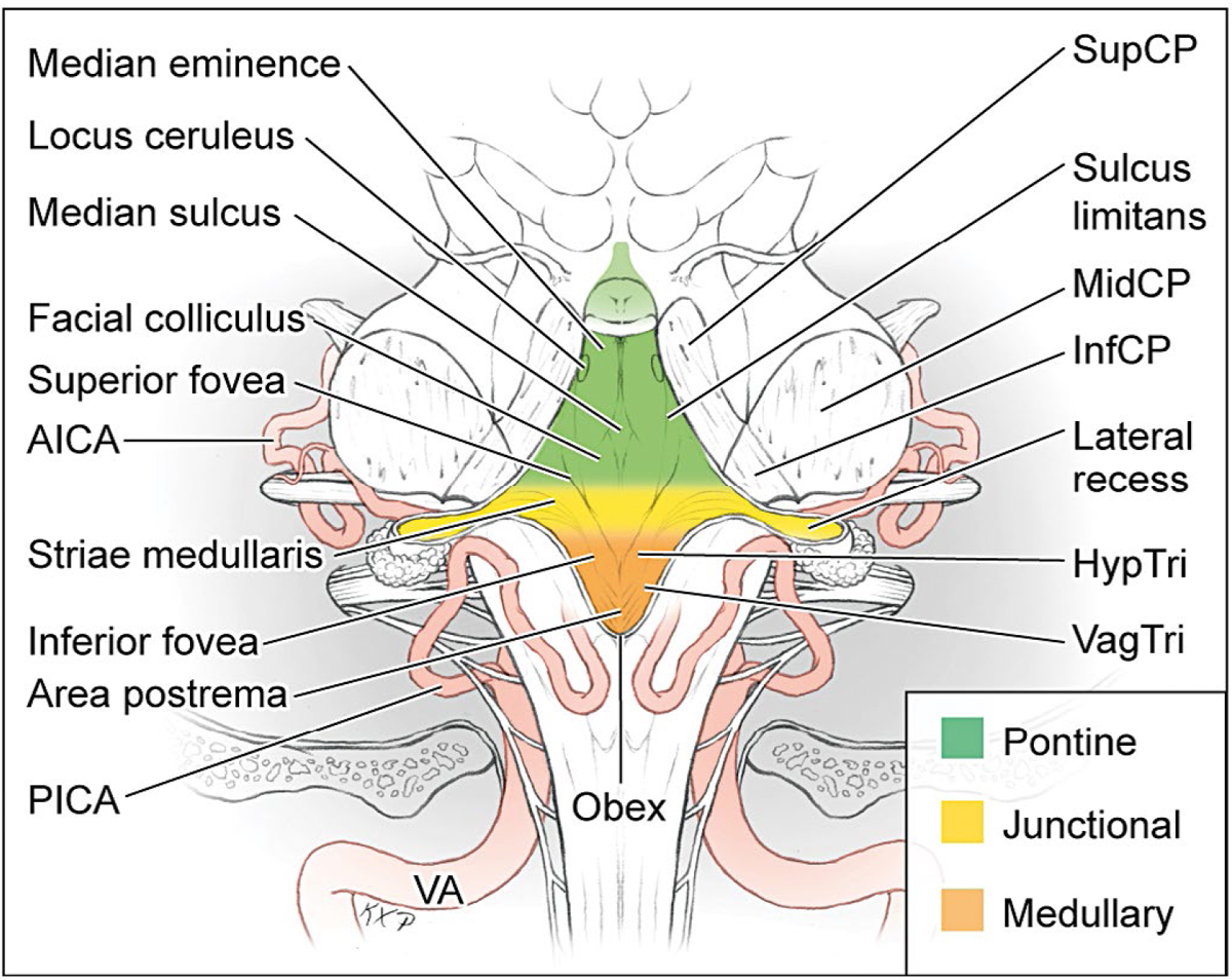 Brainstem Arteriovenous Malformations Neupsy Key