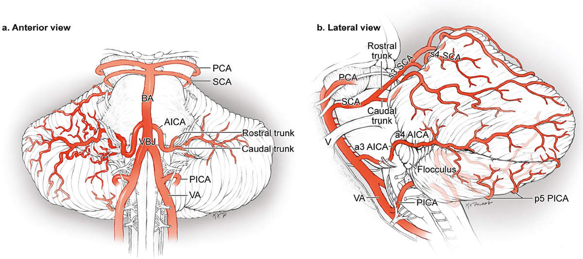 most likely source to cause pica artery infarction