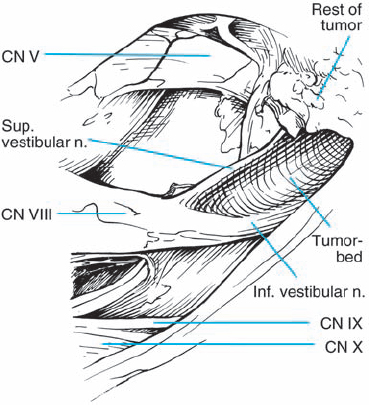 Neurinomas of the Vestibular Nerves | Neupsy Key