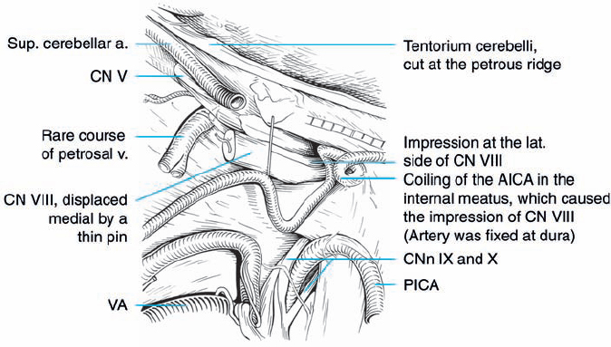 Microanatomy Of The Cerebellopontine Angle Neupsy Key 0419