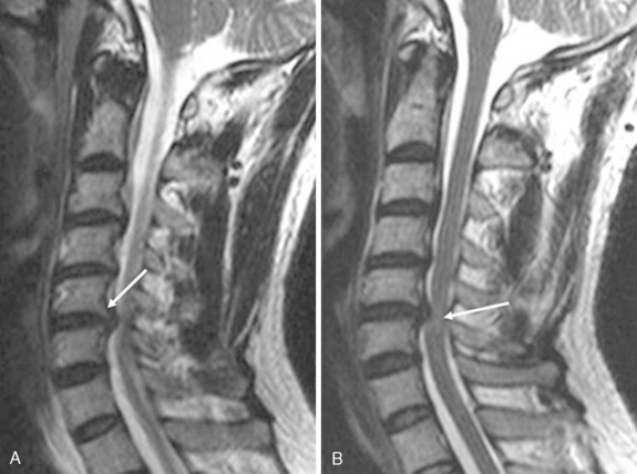 osteophyte formation lumbar spine