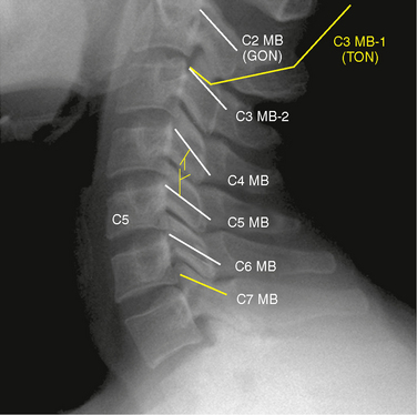 Ton Cervical Medial Branch Block