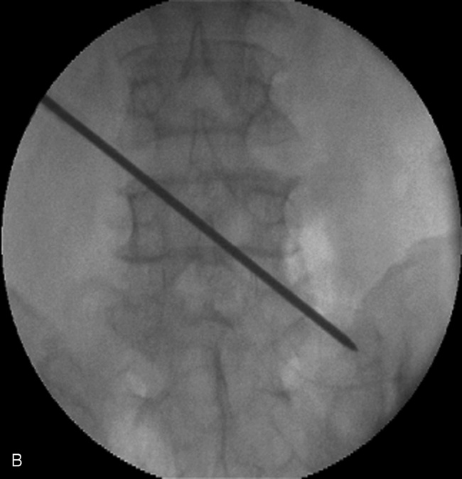 Percutaneous Translaminar Facet Pedicle Screw Fixation | Neupsy Key