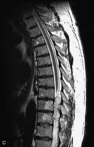 Radiographic Evaluation of Lesions within the Vertebrae | Neupsy Key