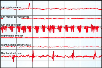 Electrodiagnostic Evaluation Of Spinal Tumors | Neupsy Key