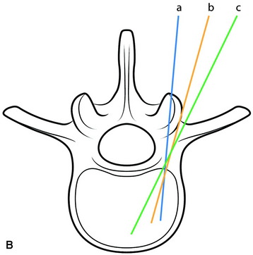 Posterior Lumbar and Lumbosacral Junction Stabilization | Neupsy Key