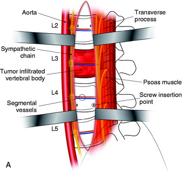 Anterior Lumbar Stabilization | Neupsy Key