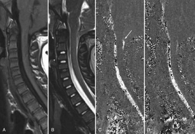 Radiology of the Spine | Neupsy Key