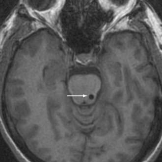 Emerging and Experimental Neurosurgical Treatments for Parkinson’s ...